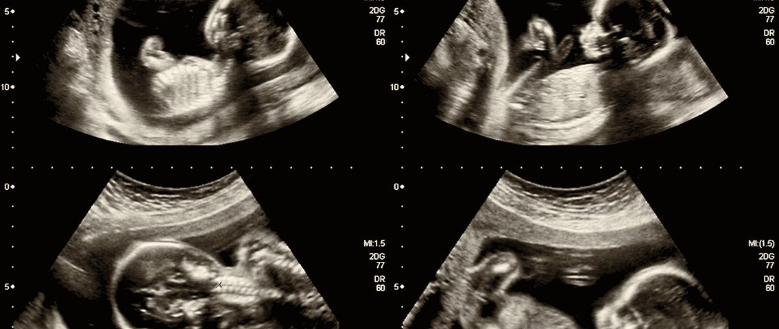 Collage de imágenes médicas de ultrasonido durante el embarazo de la mujer