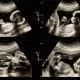 Collage de imágenes médicas de ultrasonido durante el embarazo de la mujer